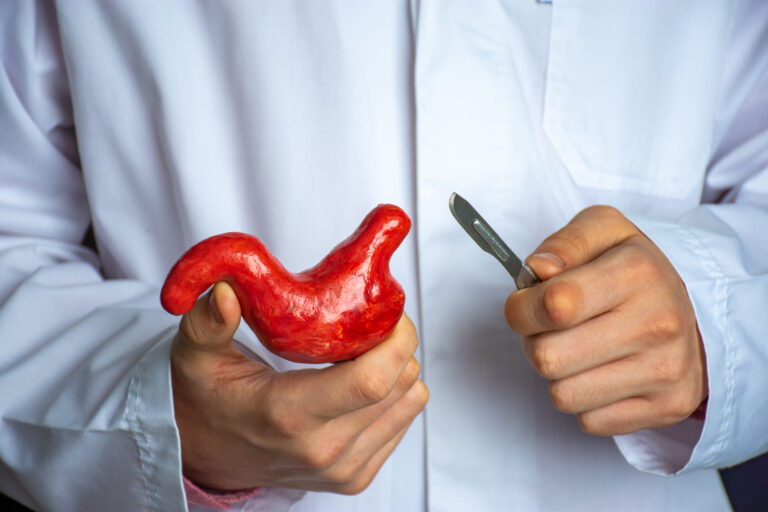 Sleeve Gastrectomy vs. Gastric Bypass: Understanding the Differences - Surgeon held scalpel over anatomical model of human stomach, holding it in his hand against background of body in a white uniform. Concept photo surgical treatment of stomach ailments and procedures